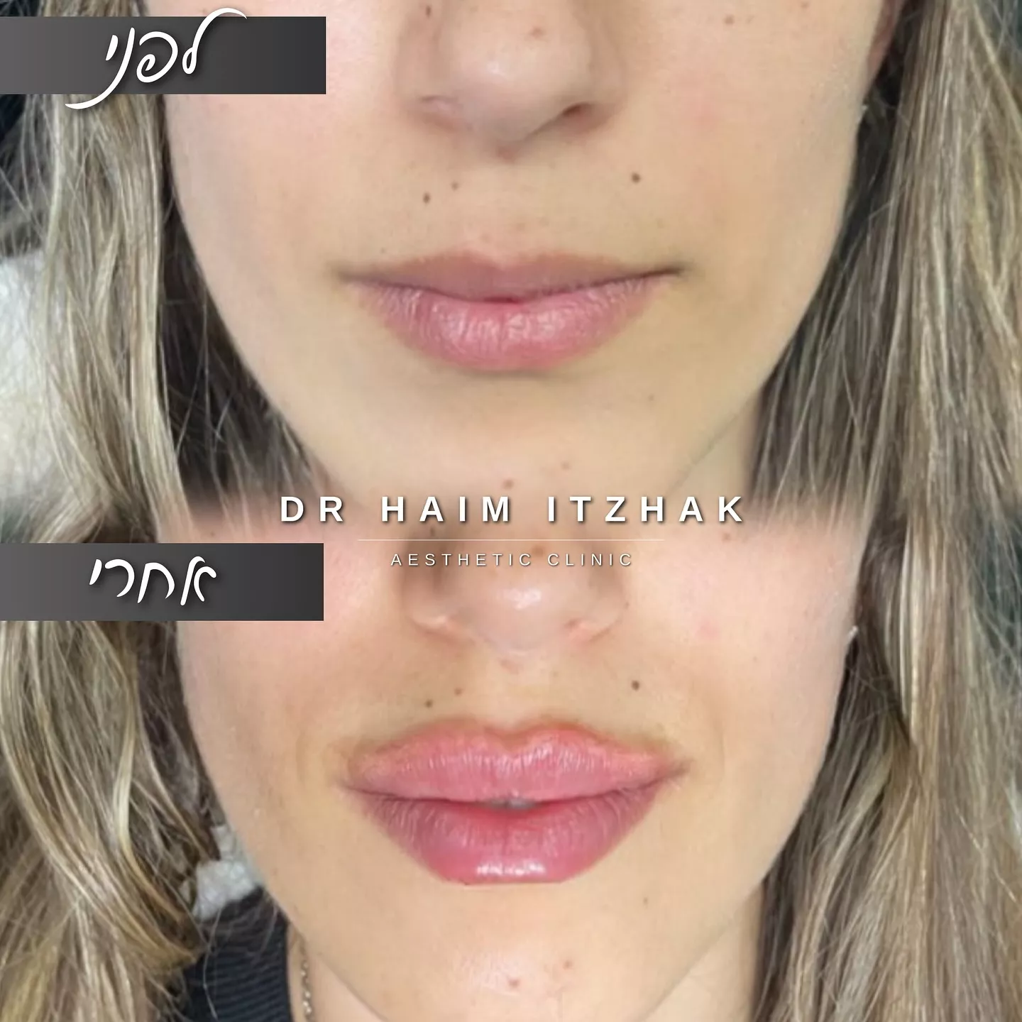 חומצה היאלורונית באילת